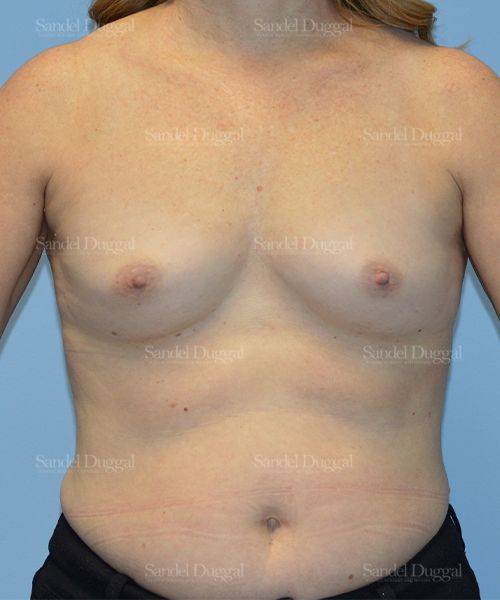 Breast Augmentation before, case 3094