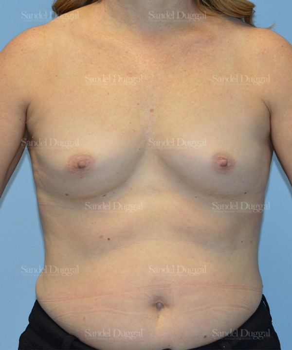 Breast Augmentation before, case 3094