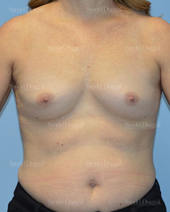 Breast Augmentation before, case 3094
