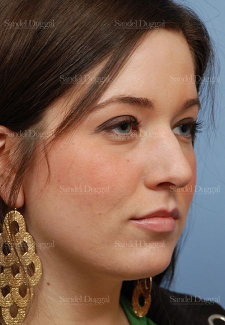 Rhinoplasty before, case 2894