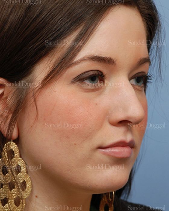 Rhinoplasty before, case 2894