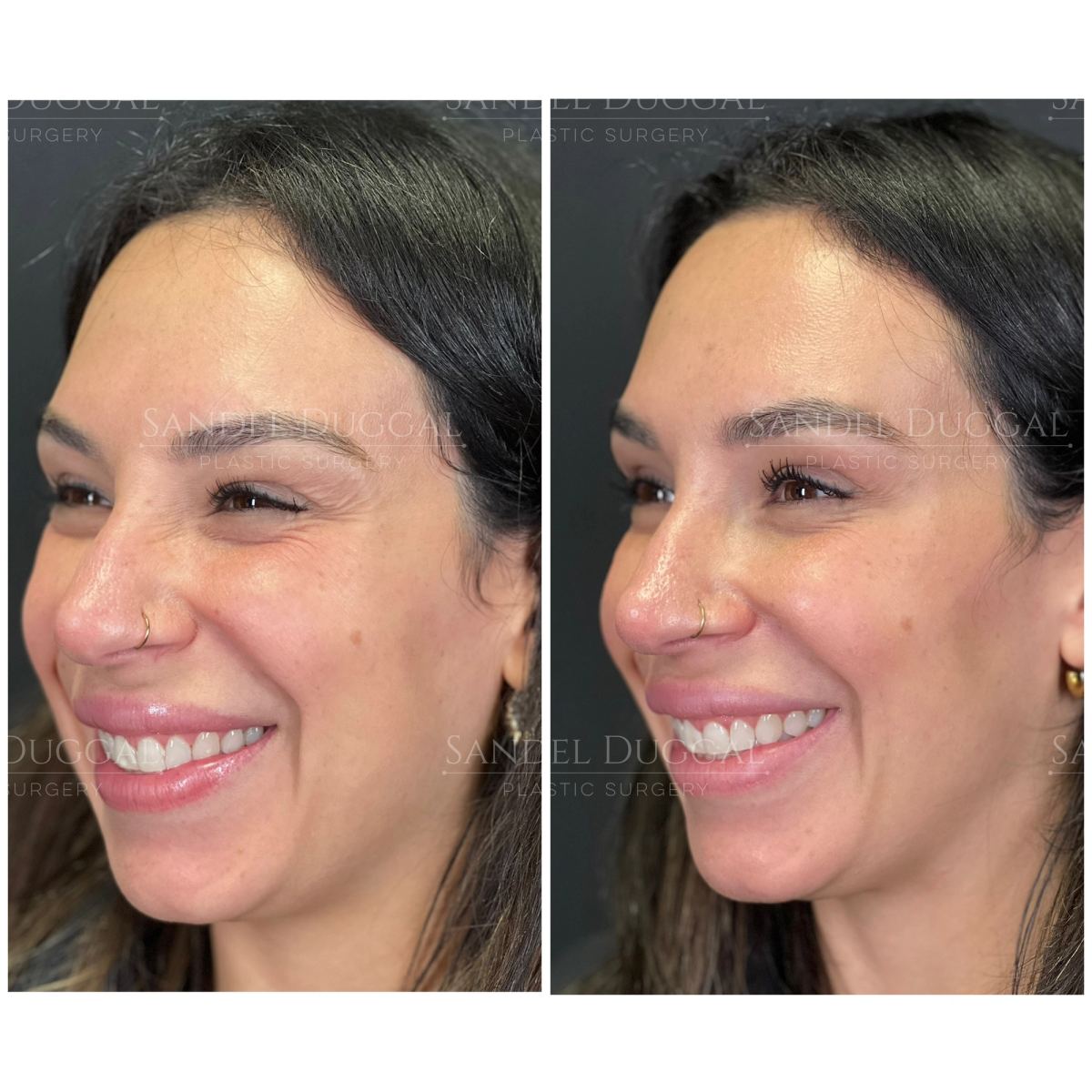 Botox & Fillers before and after, case 6013