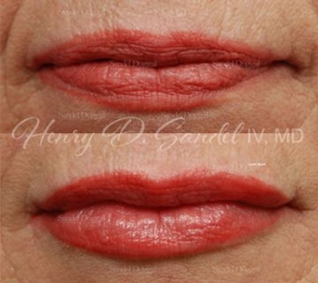 Lip Augmentation / Lip Lift before and after, case 4407