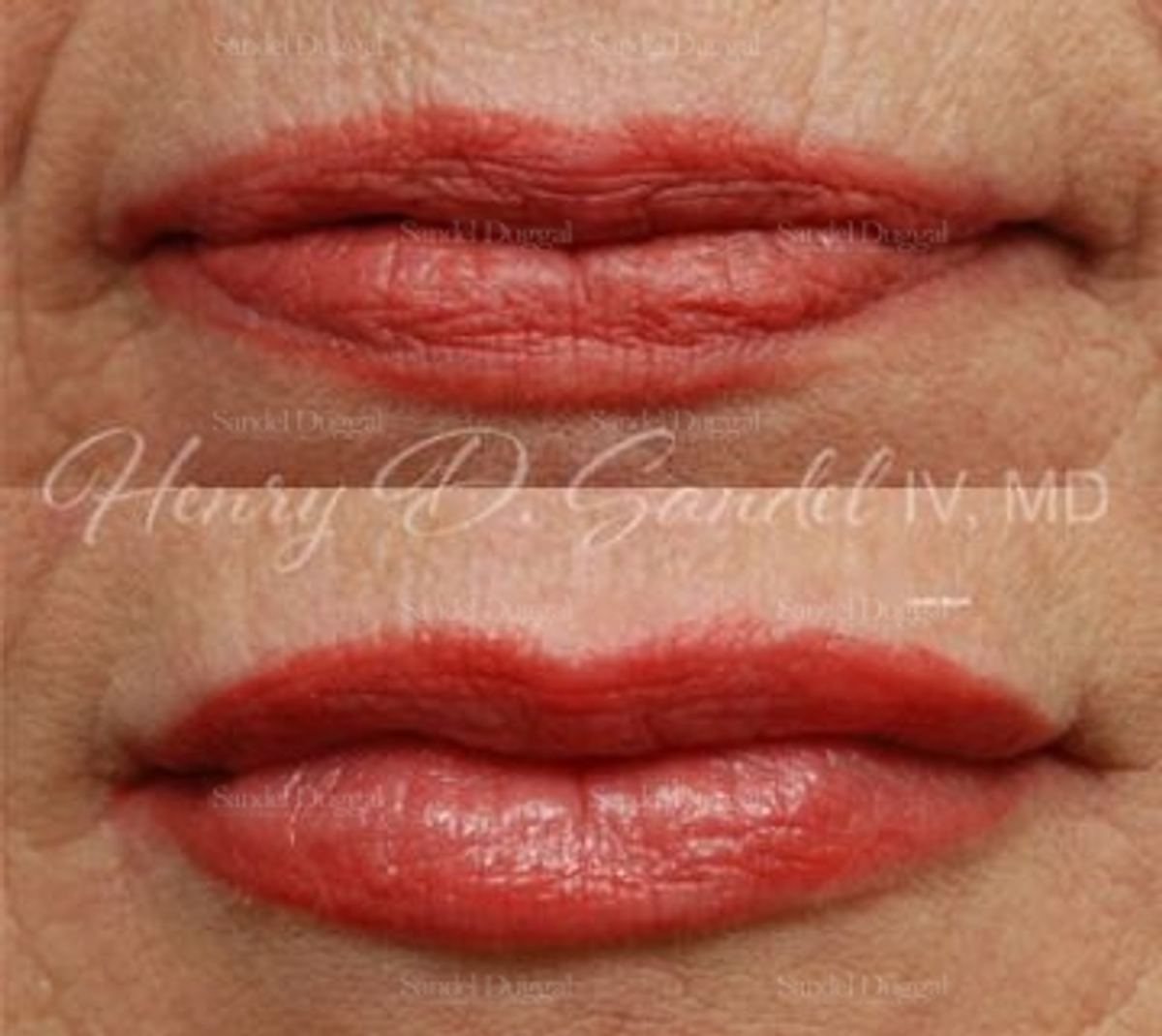 Lip Augmentation / Lip Lift before and after, case 4407