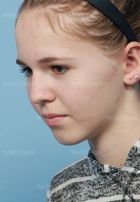 Otoplasty after, case 2598