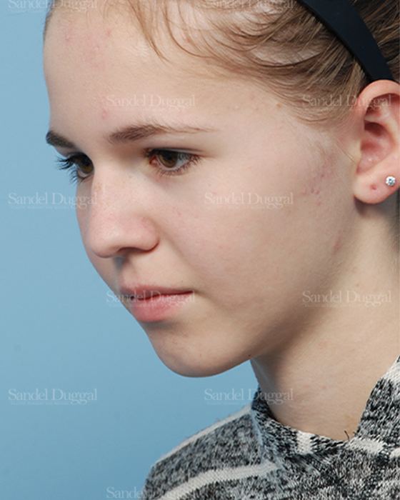 Otoplasty after, case 2598