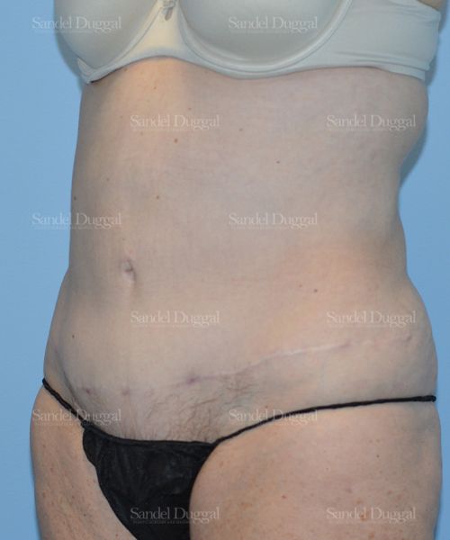 Liposuction — Abdomen after, case 2464