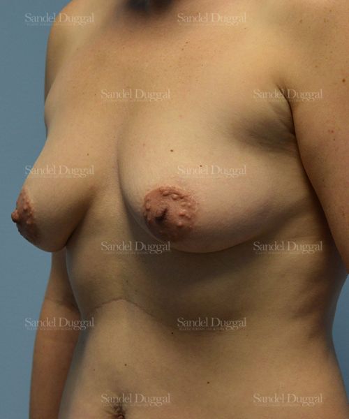 Breast Augmentation with Lift before, case 3456