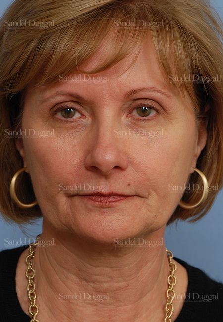 Facelift before, case 2702