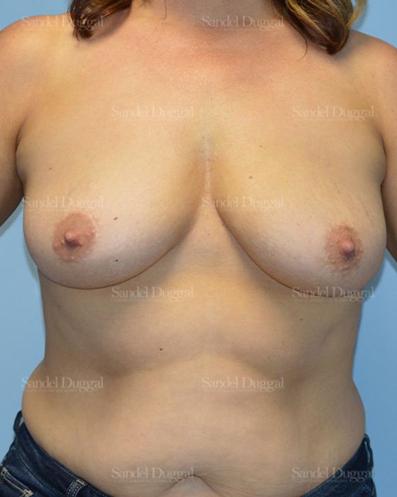 Breast Augmentation before, case 3206