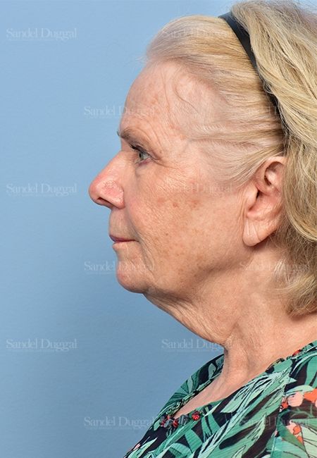 Facelift before, case 5337