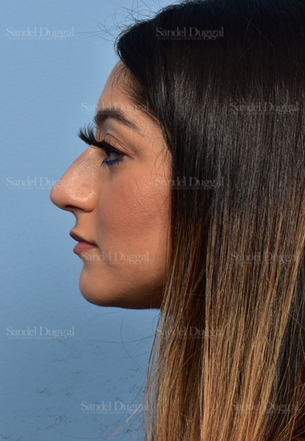 Non-Surgical Rhinoplasty after, case 5372