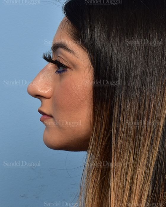 Non-Surgical Rhinoplasty after, case 5372