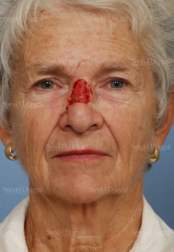 Reconstruction after Mohs before, case 2787