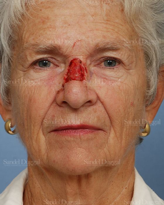 Reconstruction after Mohs before, case 2787
