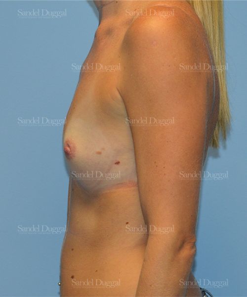 Breast Augmentation before, case 771