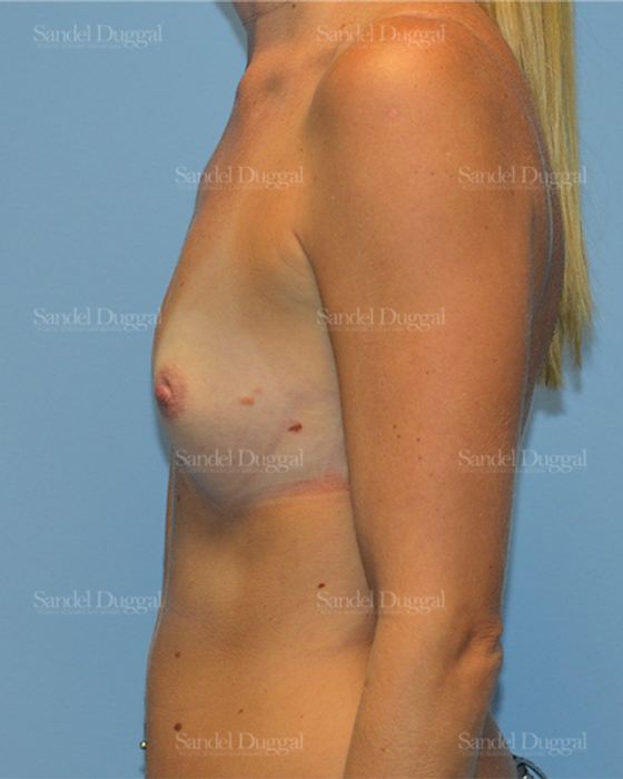 Breast Augmentation before, case 771