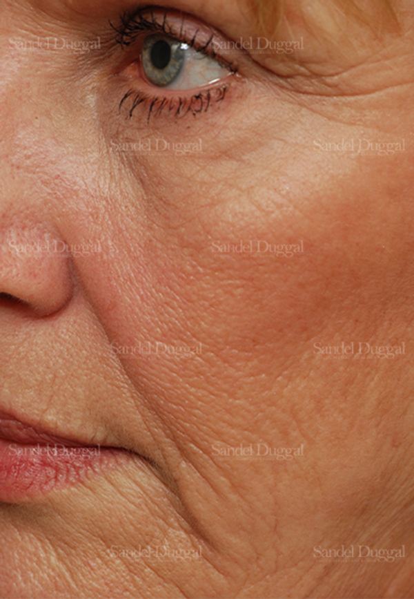 Laser Skin Resurfacing before, case 2938