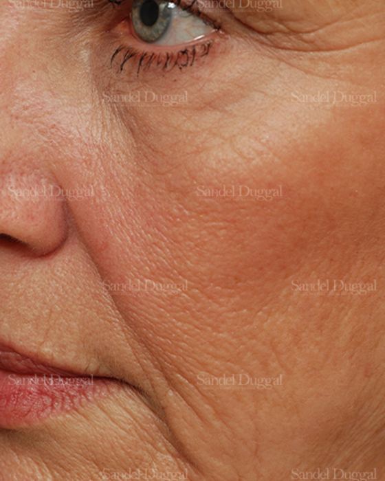 Laser Skin Resurfacing before, case 2938