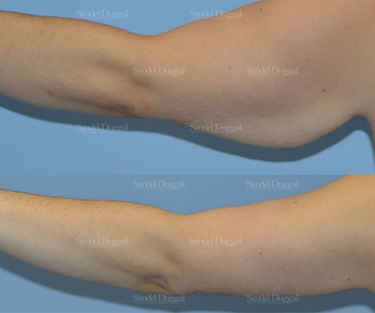 Brachioplasty before and after, case 2156