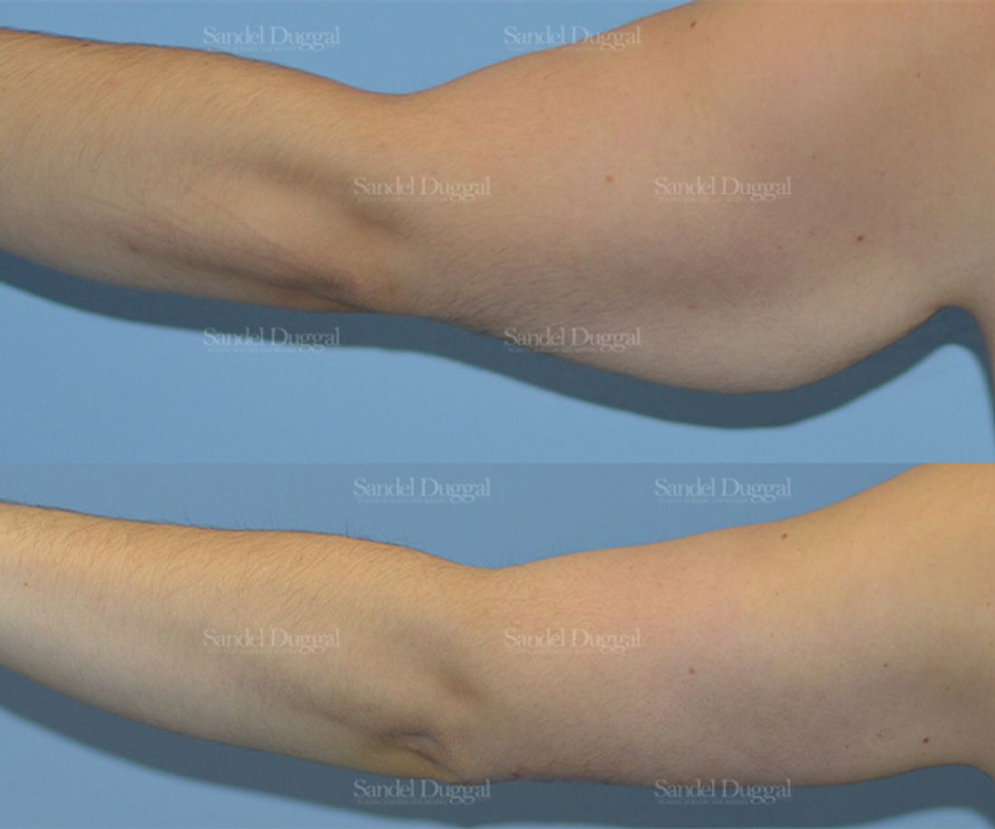 Brachioplasty before and after, case 2156