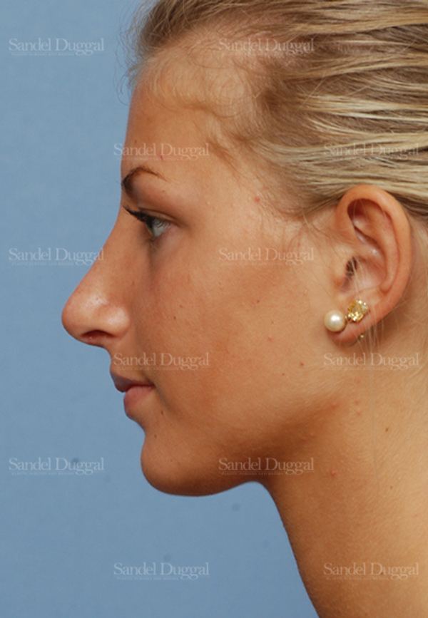 Rhinoplasty after, case 2876