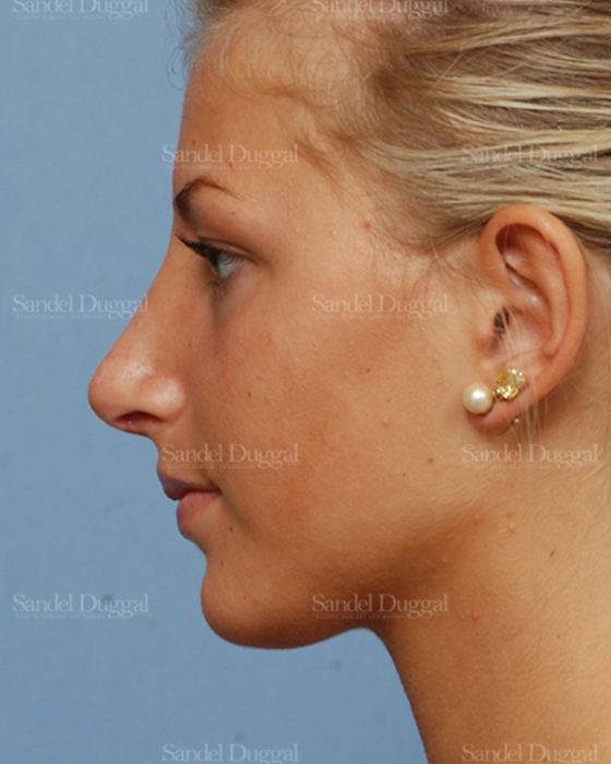 Rhinoplasty after, case 2876