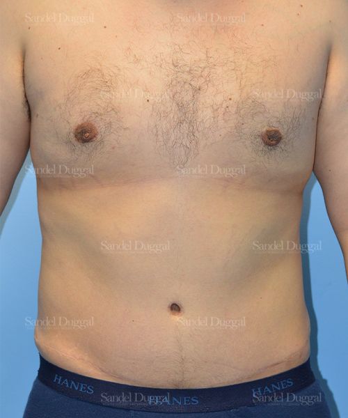Liposuction — Legs & Flanks after, case 2545