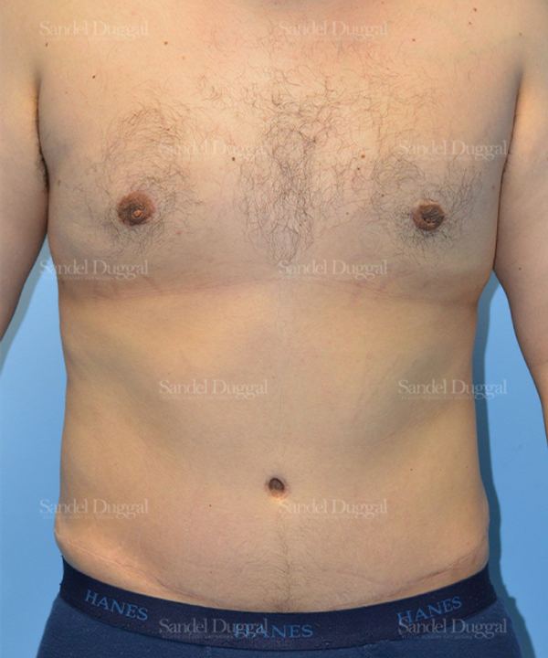 Liposuction — Legs & Flanks after, case 2545