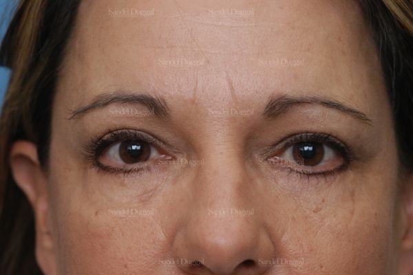 Forehead Lift after, case 2226