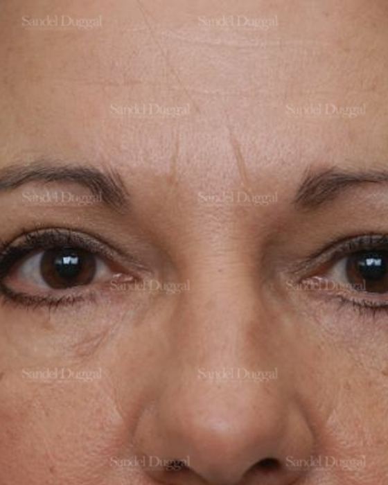 Forehead Lift after, case 2226