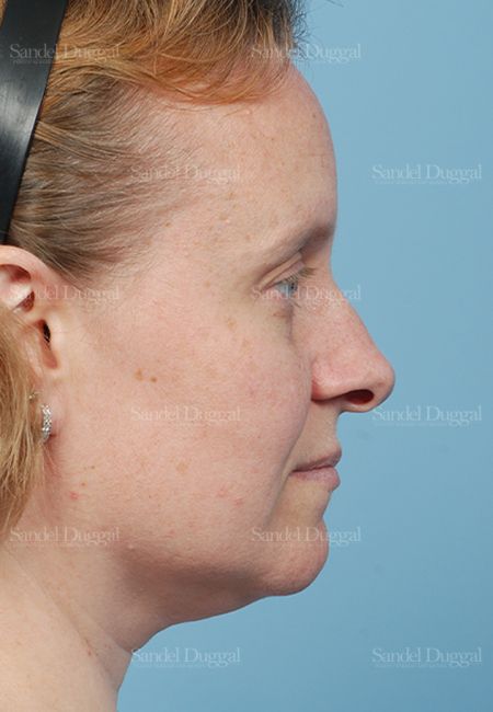 Rhinoplasty before, case 2862