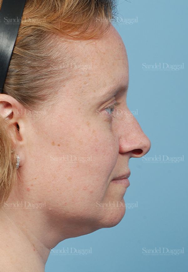 Rhinoplasty before, case 2862