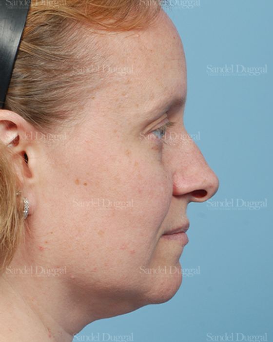 Rhinoplasty before, case 2862