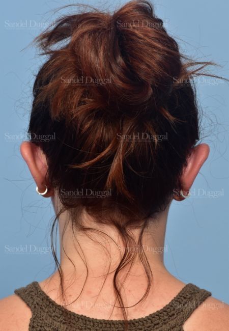Otoplasty after, case 4073