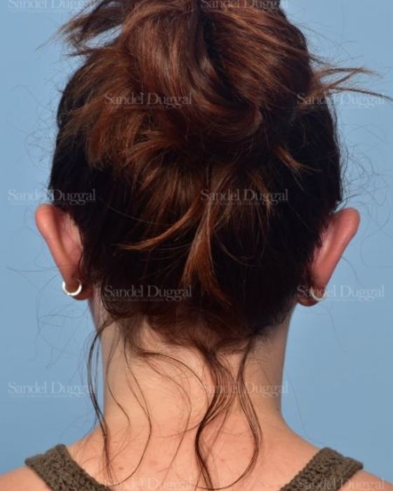 Otoplasty after, case 4073