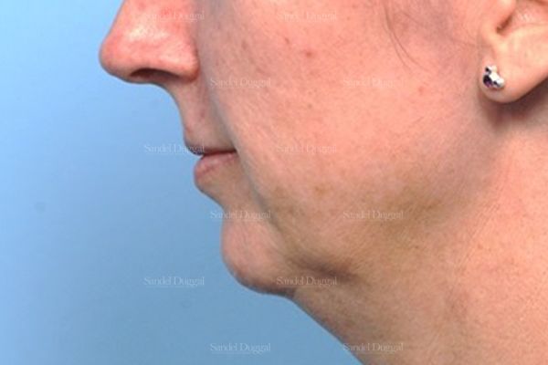 Chin Augmentation before, case 1479