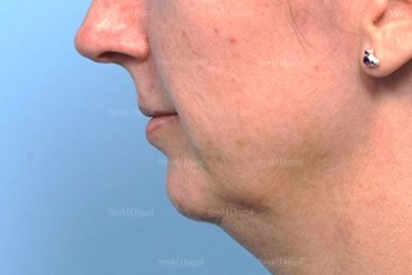 Chin Augmentation before, case 1479