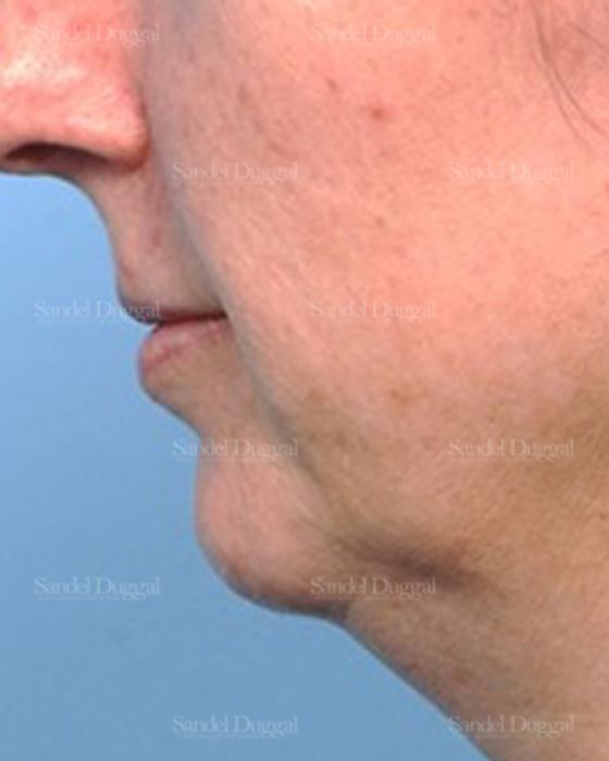 Chin Augmentation before, case 1479