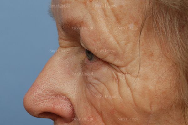 Eyelid Rejuvenation before, case 1951