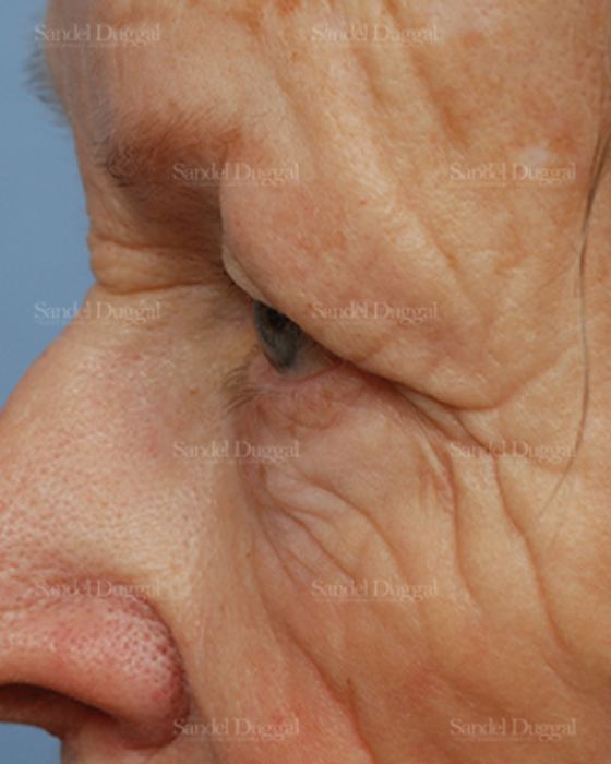 Eyelid Rejuvenation before, case 1951