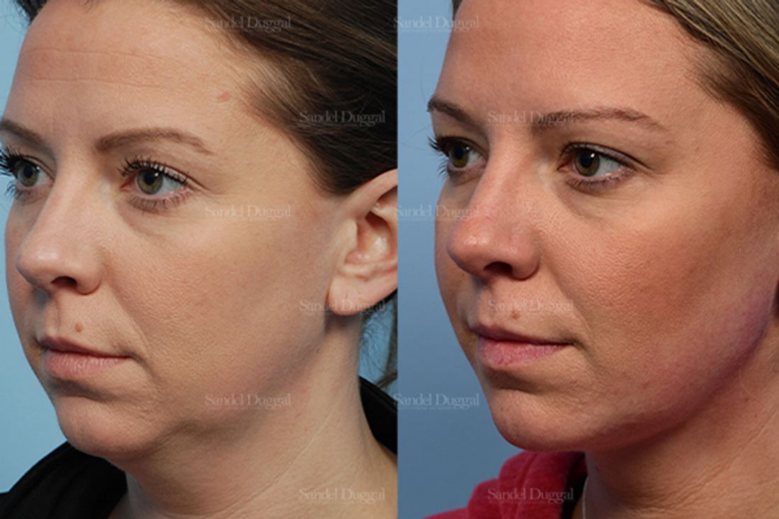 Neck & Chin Liposuction before and after, case 2550