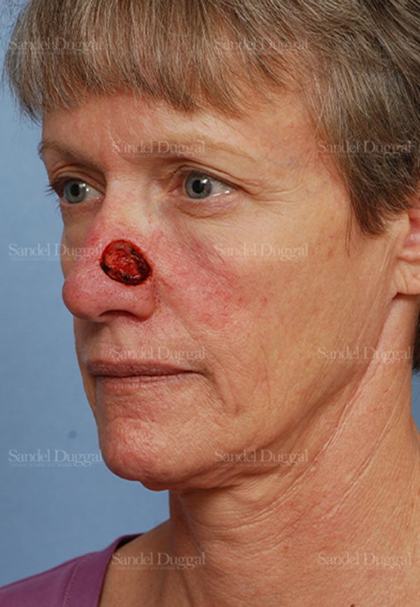 Reconstruction after Mohs before, case 2784