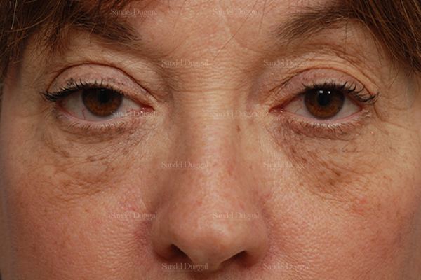 Eyelid Rejuvenation before, case 831