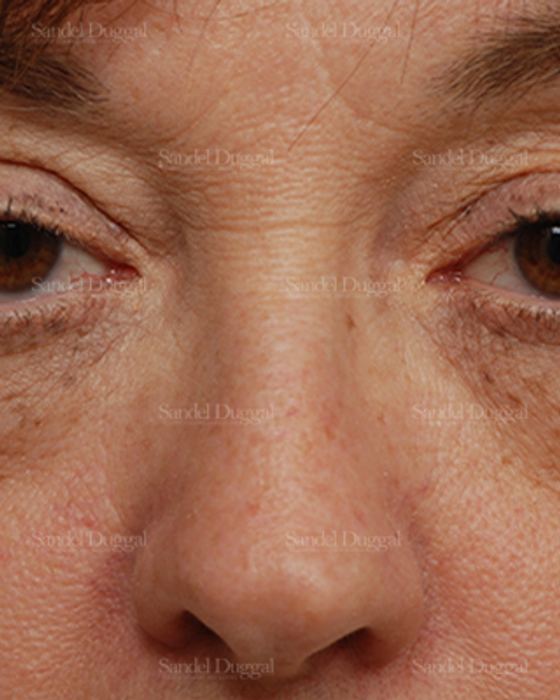 Eyelid Rejuvenation before, case 831