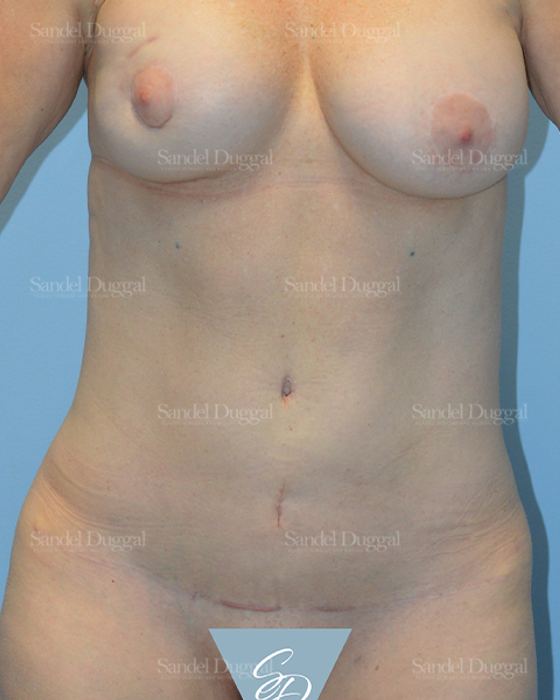 Tummy Tuck after, case 1715