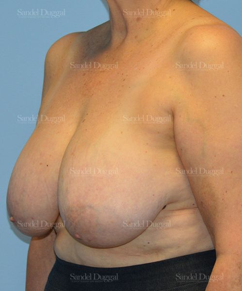 Breast Lift before, case 3287