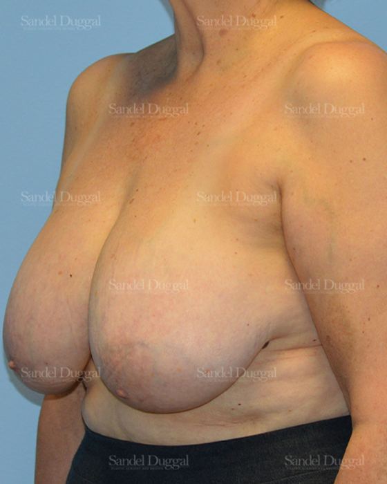 Breast Lift before, case 3287