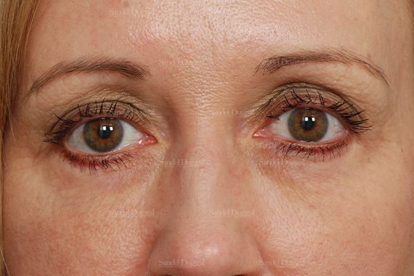 Eyelid Rejuvenation after, case 1917