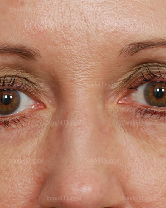 Eyelid Rejuvenation after, case 1917